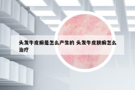 头发牛皮癣是怎么产生的 头发牛皮肤癣怎么治疗