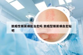 脓疱性银屑病能治愈吗 脓疱型银屑病自愈贴吧