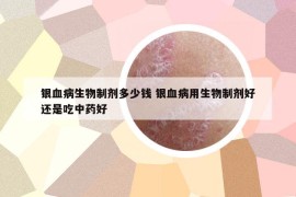 银血病生物制剂多少钱 银血病用生物制剂好还是吃中药好