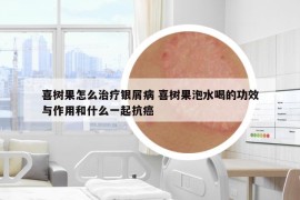 喜树果怎么治疗银屑病 喜树果泡水喝的功效与作用和什么一起抗癌