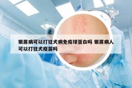 银屑病可以打狂犬病免疫球蛋白吗 银屑病人可以打狂犬疫苗吗