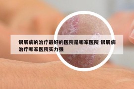 银屑病的治疗最好的医院是哪家医院 银屑病治疗哪家医院实力强