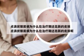 点滴状银屑病为什么在治疗期还出新的皮损 点滴状银屑病为什么在治疗期还出新的皮损呢