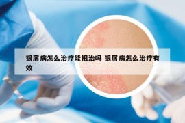 银屑病怎么治疗能根治吗 银屑病怎么治疗有效