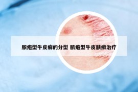 脓疱型牛皮癣的分型 脓疱型牛皮肤癣治疗