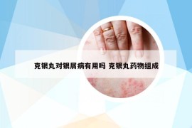 克银丸对银屑病有用吗 克银丸药物组成