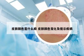 皮肤颜色是什么癣 皮肤颜色变化及提示疾病