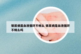 银屑病是血液循环不畅么 银屑病是血液循环不畅么吗