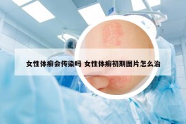 女性体癣会传染吗 女性体癣初期图片怎么治