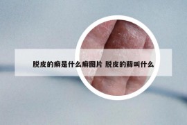 脱皮的癣是什么癣图片 脱皮的藓叫什么