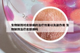 生物制剂对皮肤病的治疗效果以及副作用 生物制剂治疗皮肤病吗