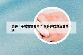 皮藓一小块慢慢变大了 皮藓掉皮然后变白一块