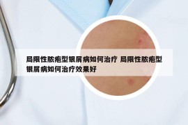 局限性脓疱型银屑病如何治疗 局限性脓疱型银屑病如何治疗效果好