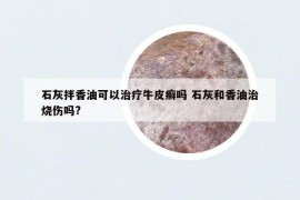 石灰拌香油可以治疗牛皮癣吗 石灰和香油治烧伤吗?