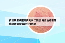 商丘银屑病医院问刘长江高超 商丘治疗银屑病郑州银屑病研究院地址