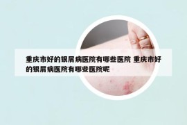 重庆市好的银屑病医院有哪些医院 重庆市好的银屑病医院有哪些医院呢