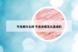 牛皮癣什么样 牛皮皮癣怎么造成的