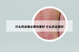 什么药去癣止痒效果好 什么药去藓好