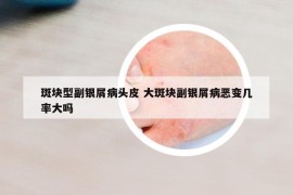 斑块型副银屑病头皮 大斑块副银屑病恶变几率大吗