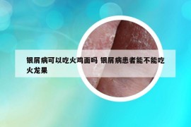 银屑病可以吃火鸡面吗 银屑病患者能不能吃火龙果