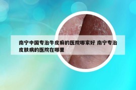 南宁中国专治牛皮癣的医院哪家好 南宁专治皮肤病的医院在哪里