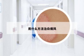 用什么方法治白癜风