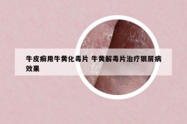 牛皮癣用牛黄化毒片 牛黄解毒片治疗银屑病效果