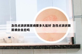 急性点滴状银屑病要多久能好 急性点滴状银屑病会自愈吗