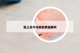 脸上出牛皮癣能敷面膜吗