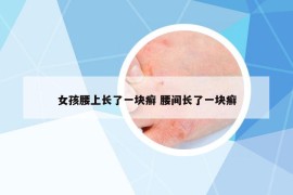 女孩腰上长了一块癣 腰间长了一块癣