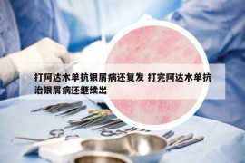 打阿达木单抗银屑病还复发 打完阿达木单抗治银屑病还继续出