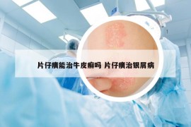 片仔癀能治牛皮癣吗 片仔癀治银屑病