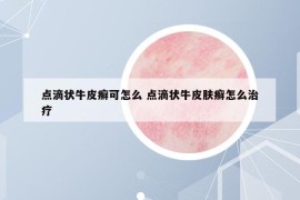 点滴状牛皮癣可怎么 点滴状牛皮肤癣怎么治疗