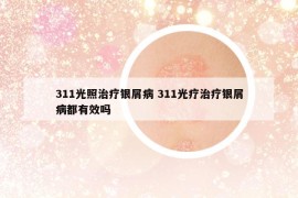 311光照治疗银屑病 311光疗治疗银屑病都有效吗