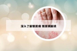 深入了解银屑病 银屑病解读