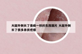 大腿外侧长了像癣一样的东西图片 大腿外侧长了很多条状疙瘩