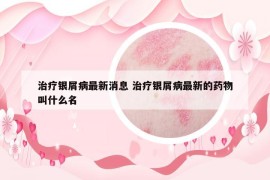 治疗银屑病最新消息 治疗银屑病最新的药物叫什么名