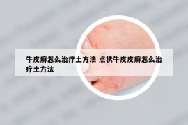 牛皮癣怎么治疗土方法 点状牛皮皮癣怎么治疗土方法