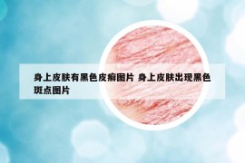 身上皮肤有黑色皮癣图片 身上皮肤出现黑色斑点图片