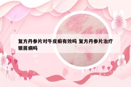 复方丹参片对牛皮癣有效吗 复方丹参片治疗银屑病吗