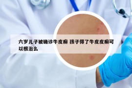 六岁儿子被确诊牛皮癣 孩子得了牛皮皮癣可以根治么