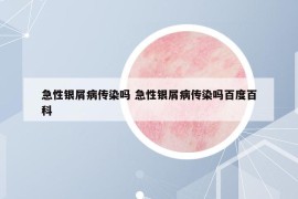 急性银屑病传染吗 急性银屑病传染吗百度百科