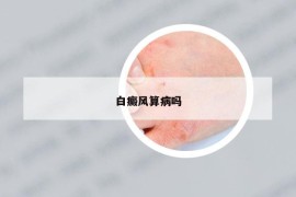 白癜风算病吗