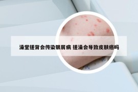 澡堂搓背会传染银屑病 搓澡会导致皮肤癌吗