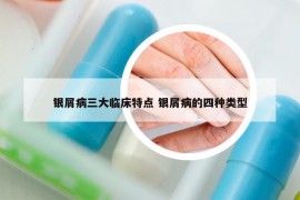 银屑病三大临床特点 银屑病的四种类型