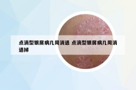 点滴型银屑病几周消退 点滴型银屑病几周消退掉