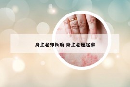 身上老师长癣 身上老是起癣