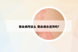 银血病传染么 银血病会遗传吗?