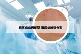 银屑病病因证型 银屑病辨证分型