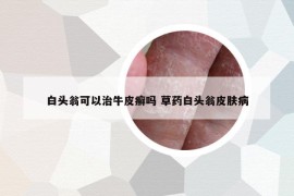 白头翁可以治牛皮癣吗 草药白头翁皮肤病